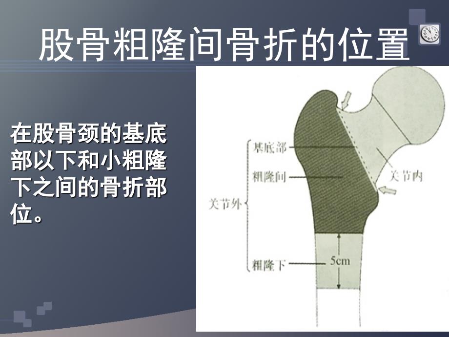 股骨粗隆间骨折术护理查房ppt课件.ppt_第3页