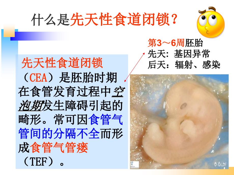食道闭锁.ppt.ppt_第3页