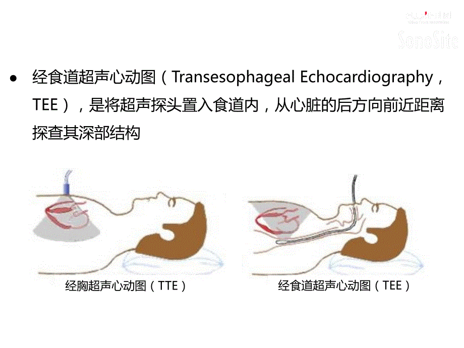 经食道超声心动图TEE应用.pptx_第3页