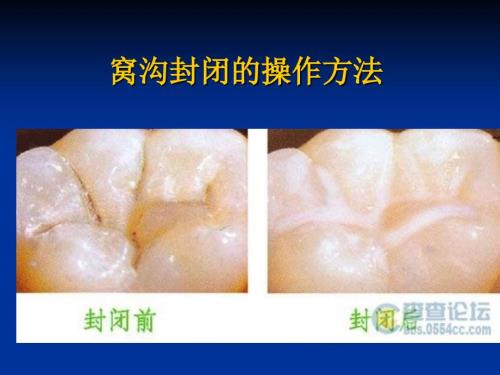 窝沟封闭PPT课件.ppt