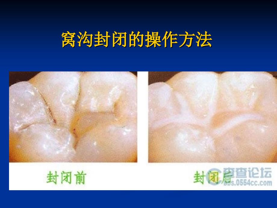 窝沟封闭PPT课件.ppt_第1页