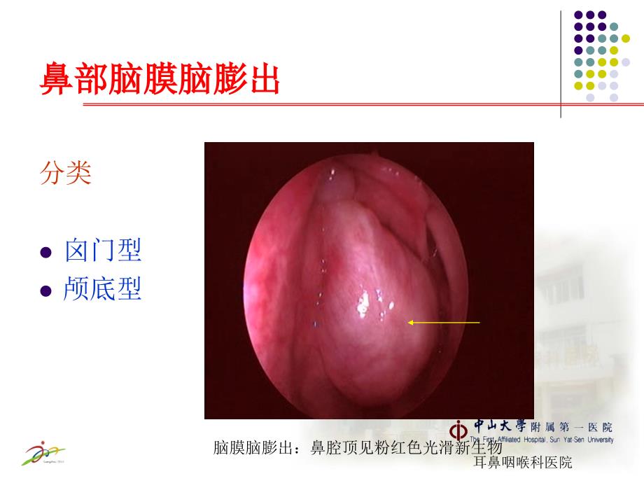 鼻部先天性疾病PPT课件.ppt_第3页
