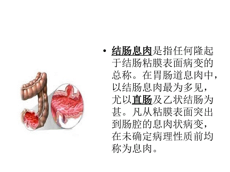 结肠息肉PPT课件.ppt_第3页