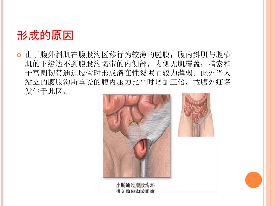 腹股沟疝手术配合PPT课件.pptx_第3页