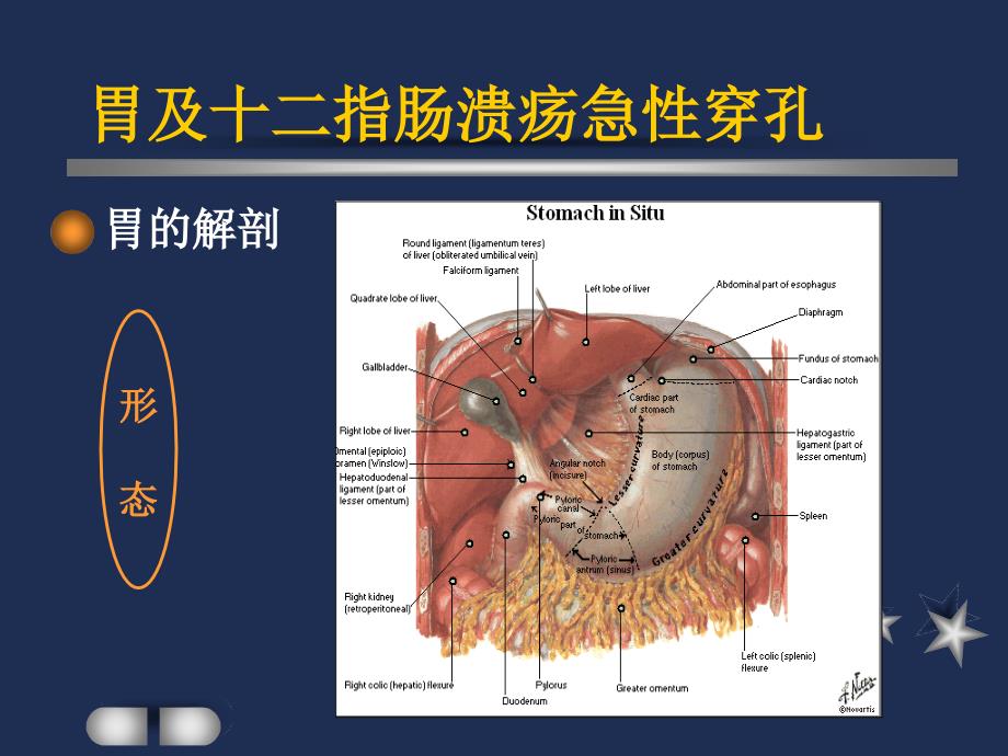 胃及十二指肠溃疡急性穿孔护理查房.ppt_第3页