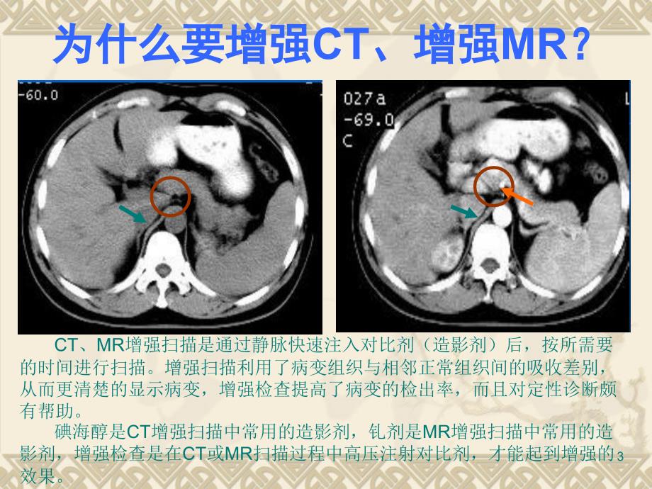 造影剂对比剂外渗预防与处理PPT课件.ppt_第3页