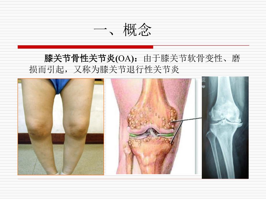 膝关节骨性关节炎.ppt_第2页