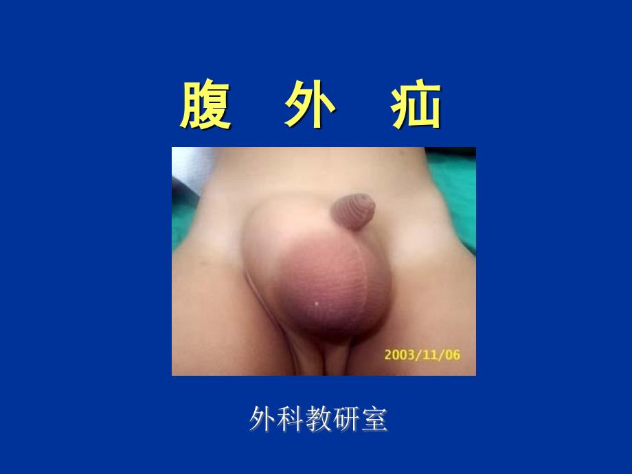 腹外疝外科治疗PPT课件.ppt_第1页