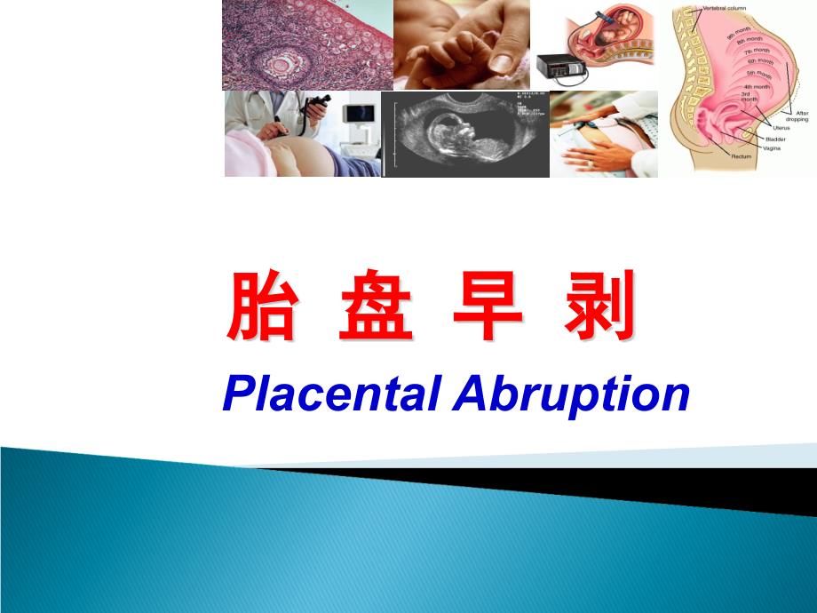 胎盘早剥PPT课件.ppt_第2页