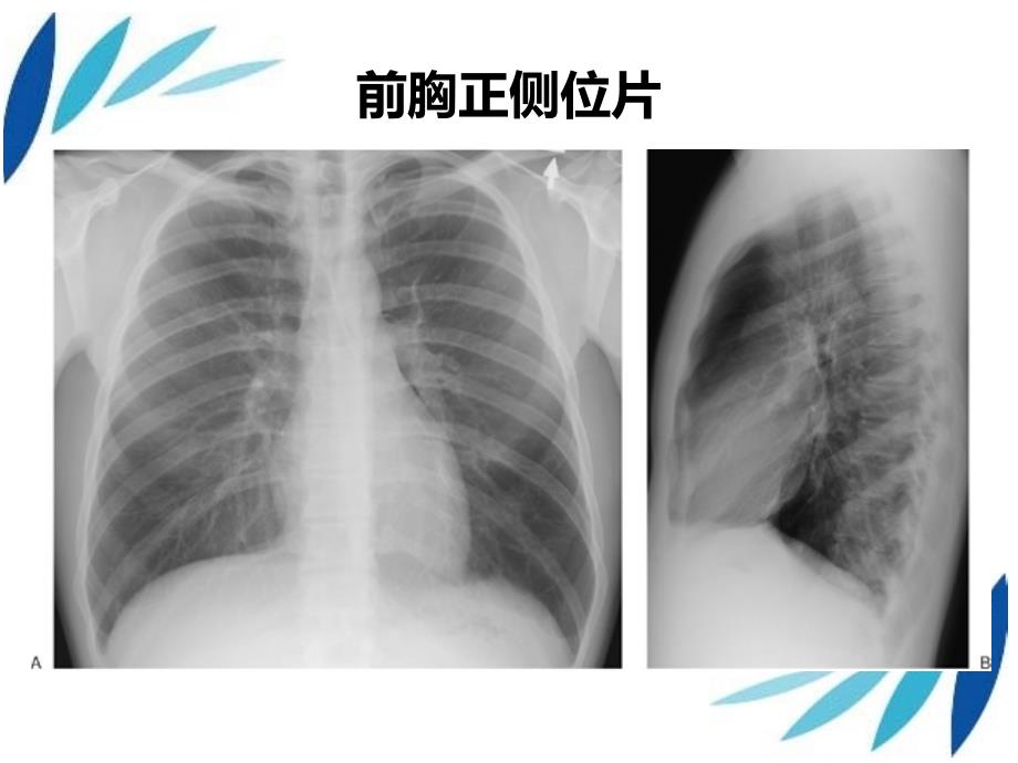 读懂胸部X光片.ppt_第2页