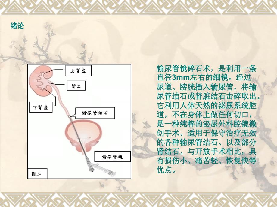 输尿管镜碎石术PPT课件.ppt_第2页