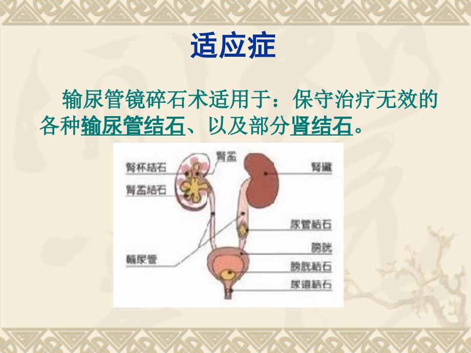 输尿管镜碎石术PPT课件.ppt_第3页