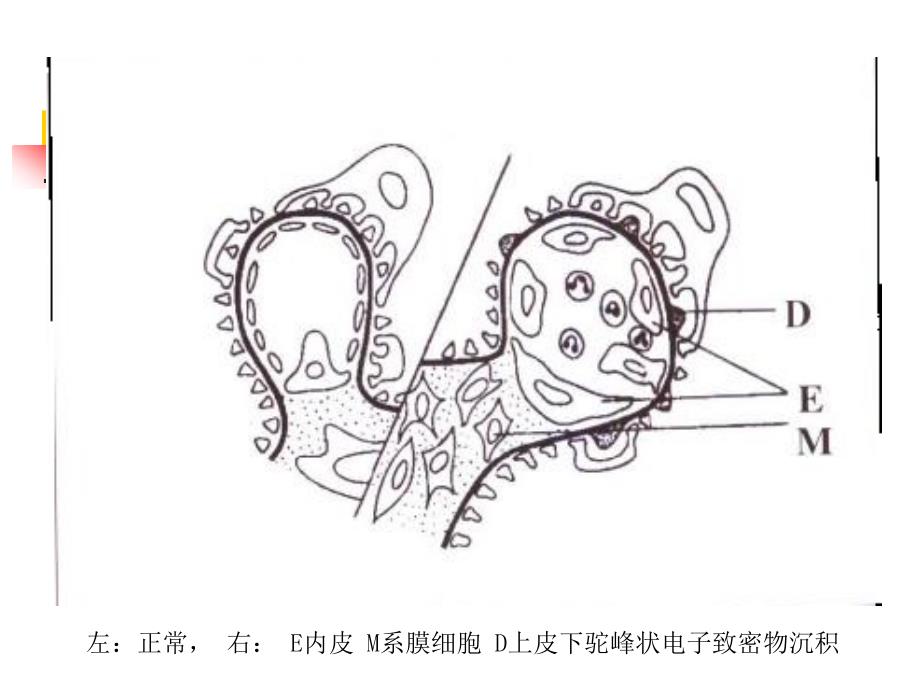 肾小球肾炎PPT课件.ppt_第3页
