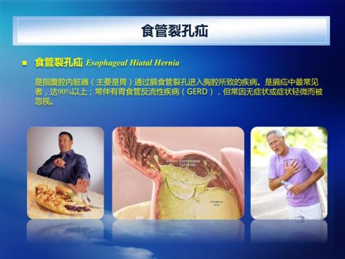 食管裂孔疝PPT课件.pptx
