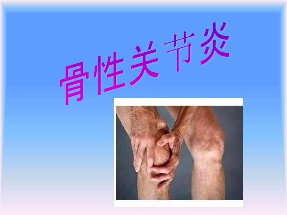 骨性关节炎ppt课件.ppt_第2页