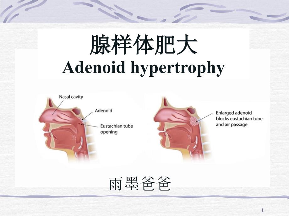 腺样体肥大PPT课件.ppt_第1页