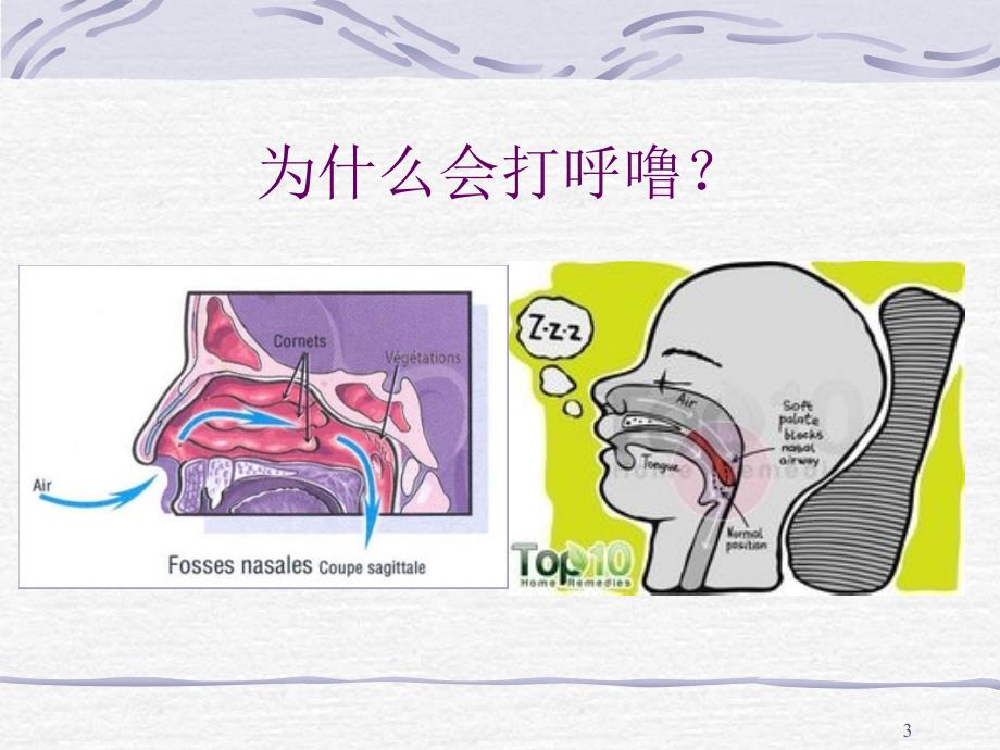 腺样体肥大PPT课件.ppt_第3页