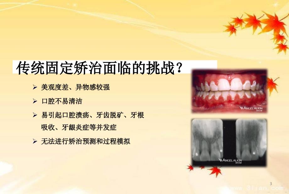 隐形矫正PPtPPT课件.ppt_第3页