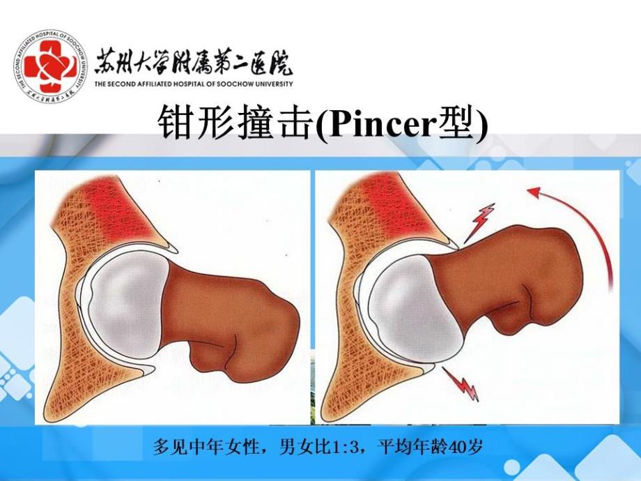 髋关节镜治疗FAI.ppt_第2页