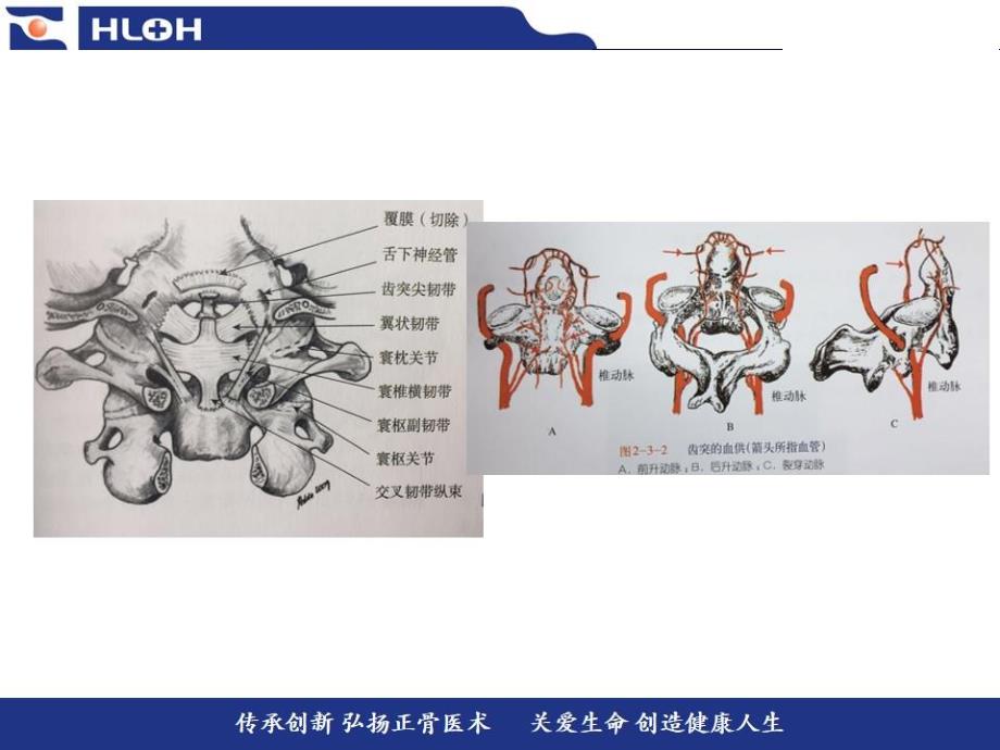 齿状突骨折的分型和微创治疗手术方法的正确选择.ppt_第3页