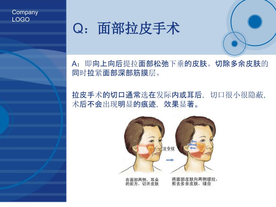面部拉皮手术PPT课件.ppt_第2页