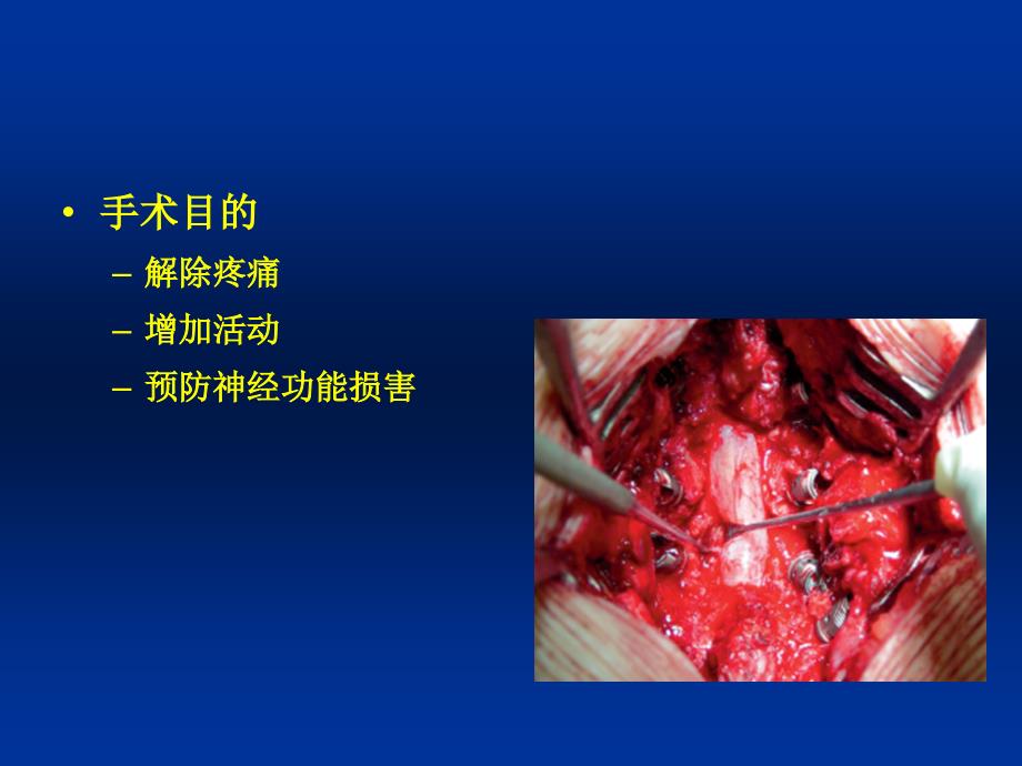 腰椎管狭窄症PPT课件.ppt_第2页