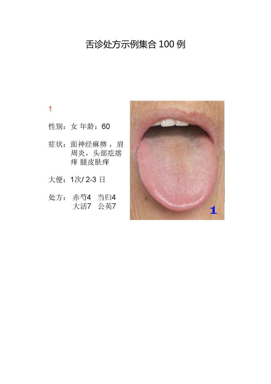 舌诊处方示例集合100例.docx_第1页