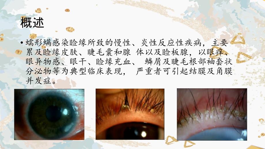 蠕形螨睑缘炎PPT课件.ppt_第2页
