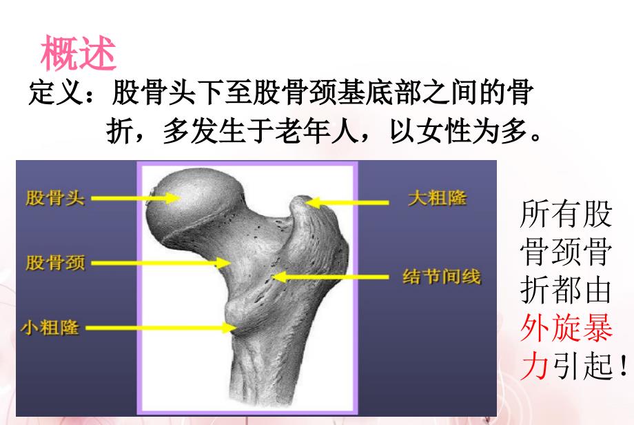 股骨颈骨折护理查房.ppt_第2页