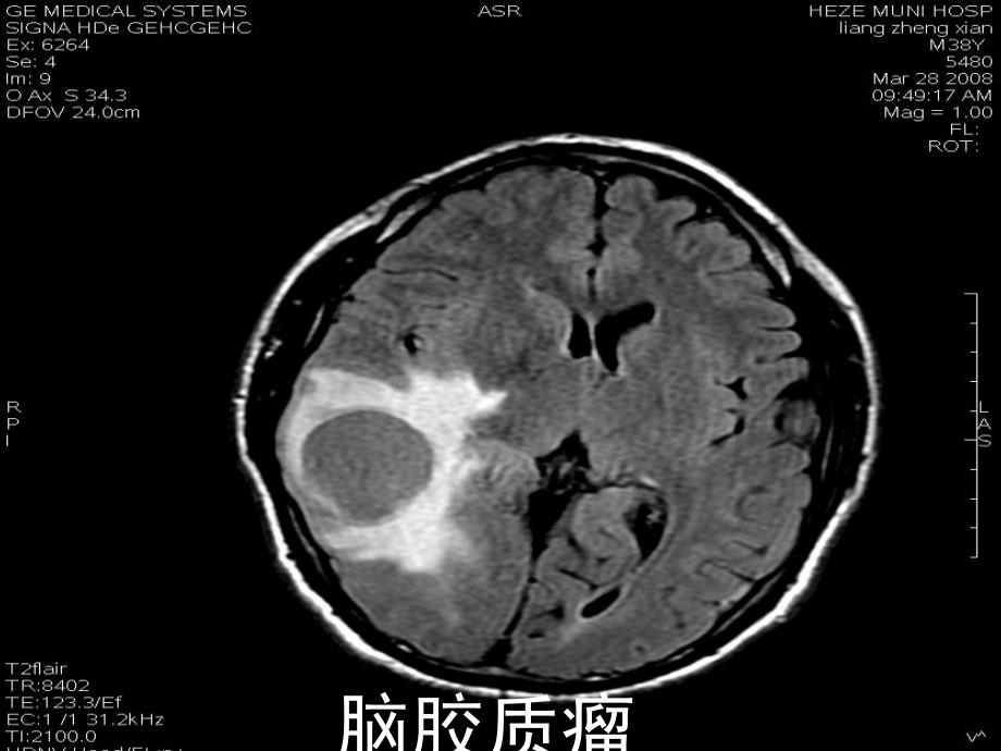 脑胶质瘤的护理.ppt_第3页