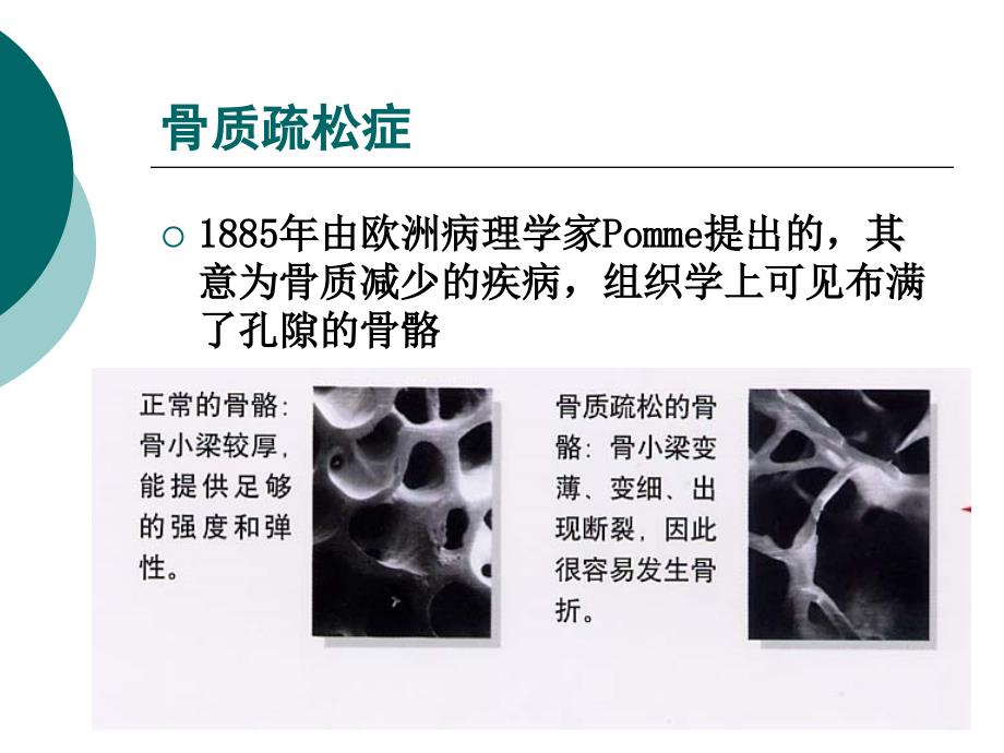 骨密度检查PPT课件.ppt_第3页