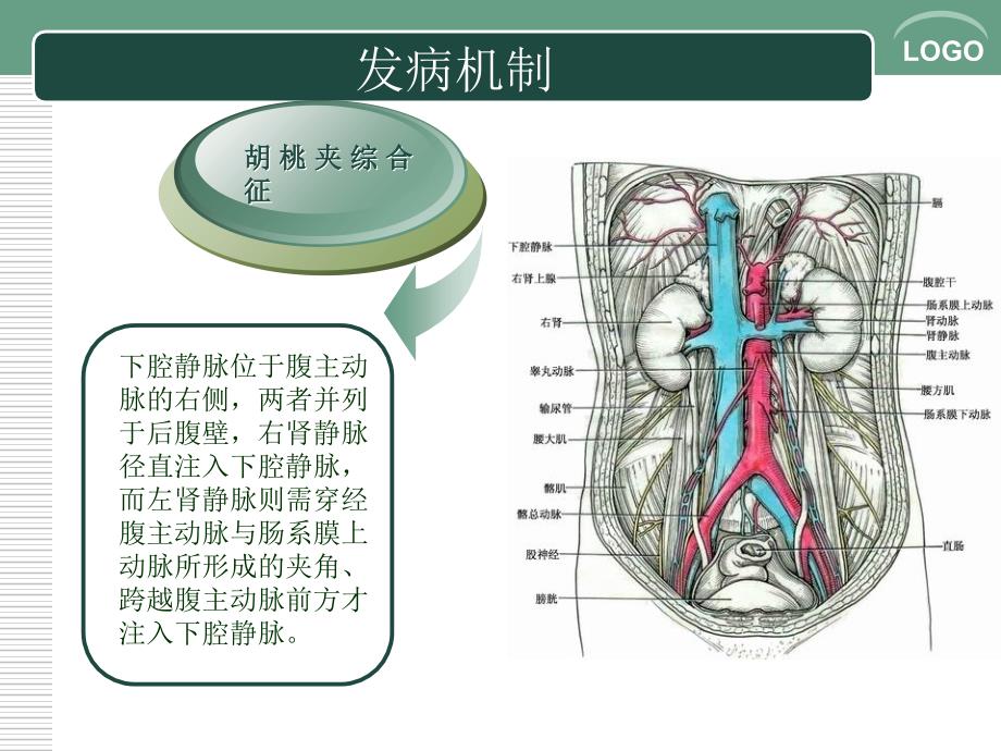胡桃夹综合征PPT课件.ppt_第3页