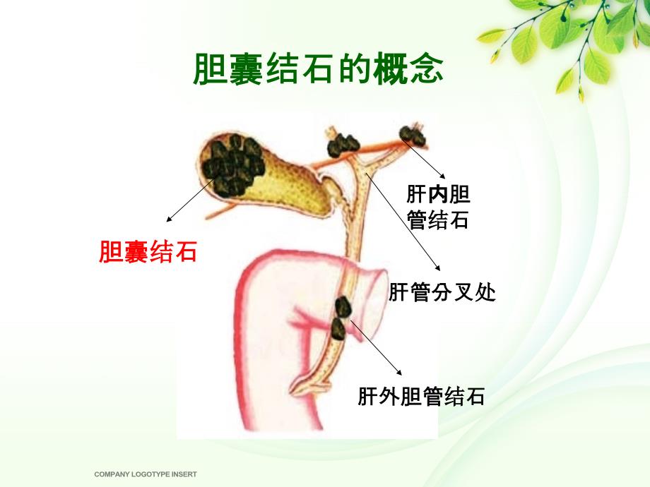 胆囊结石围手术期护理.ppt_第3页