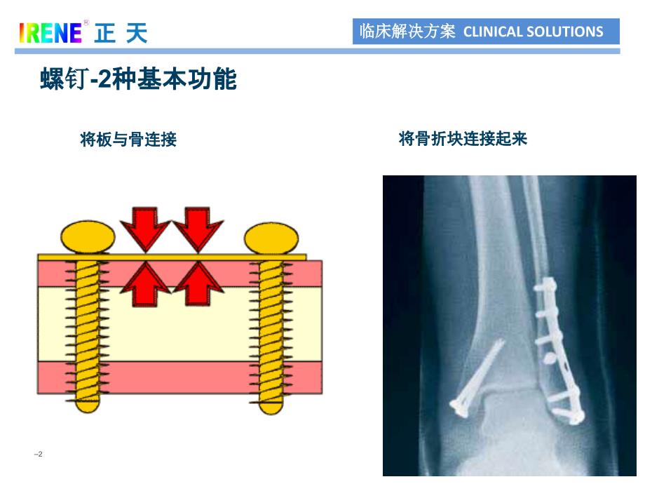 骨科基础螺钉设计与类型.ppt_第2页