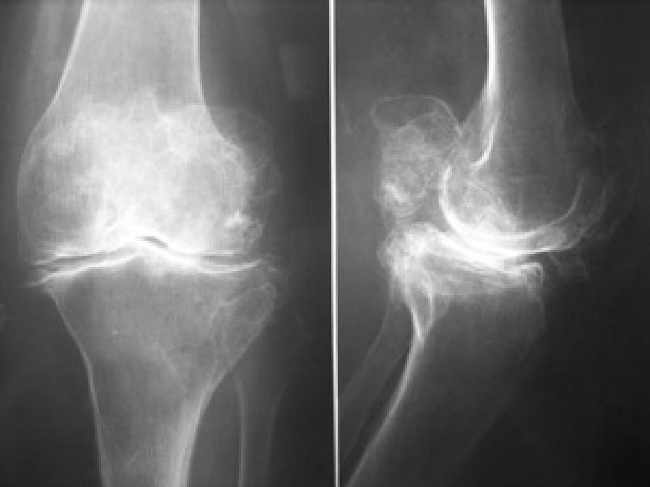 膝关节骨性关节炎生物力学机制与临床应用.ppt_第3页
