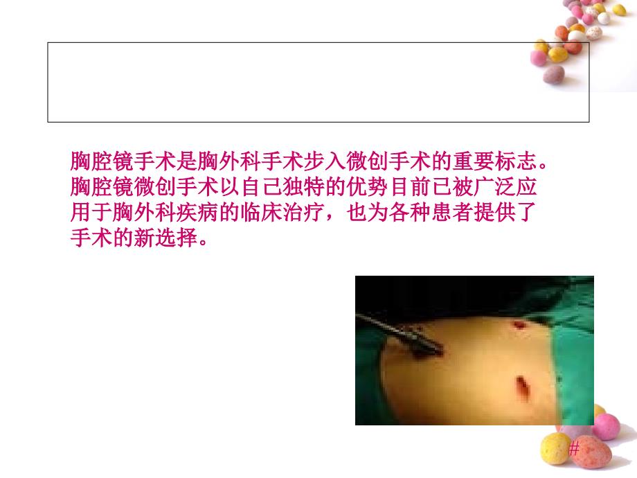 胸腔镜手术术前术后护理.ppt_第3页