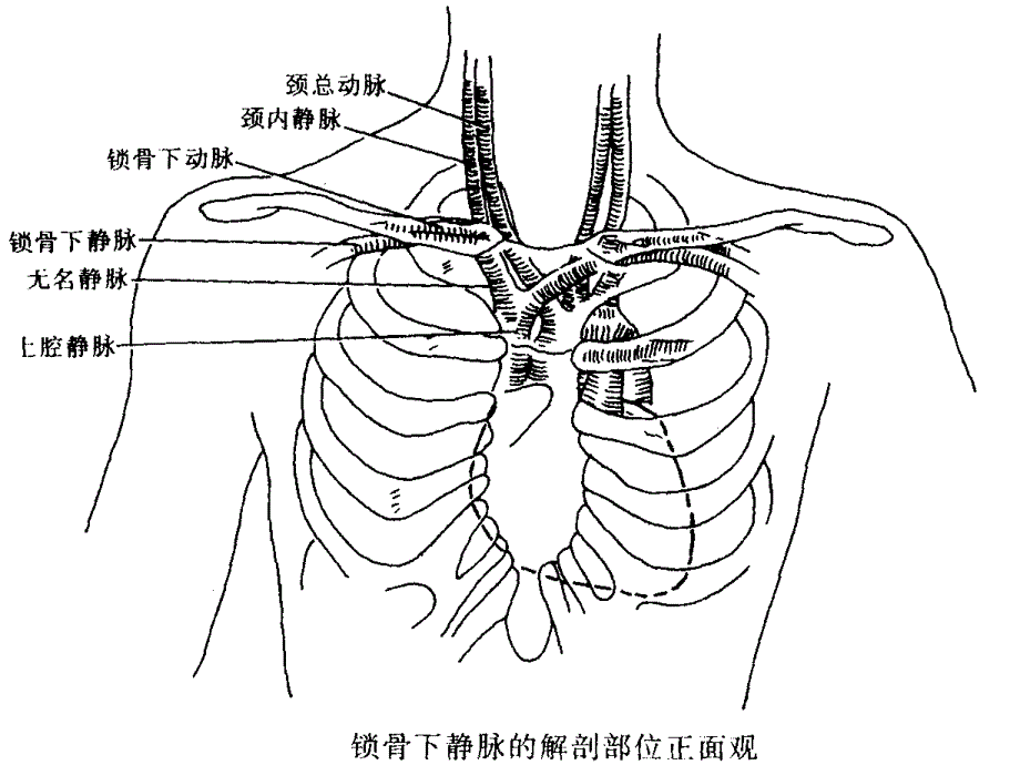 锁骨下静脉穿刺置管术课件.ppt_第3页