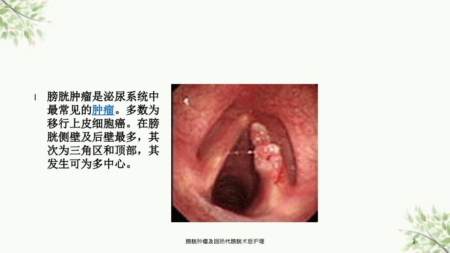 膀胱肿瘤及回肠代膀胱术后护理课件.ppt_第2页