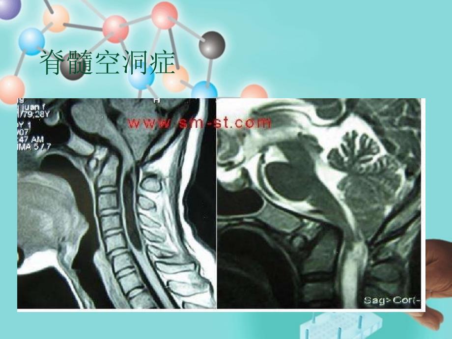 脊髓空洞症.ppt_第3页