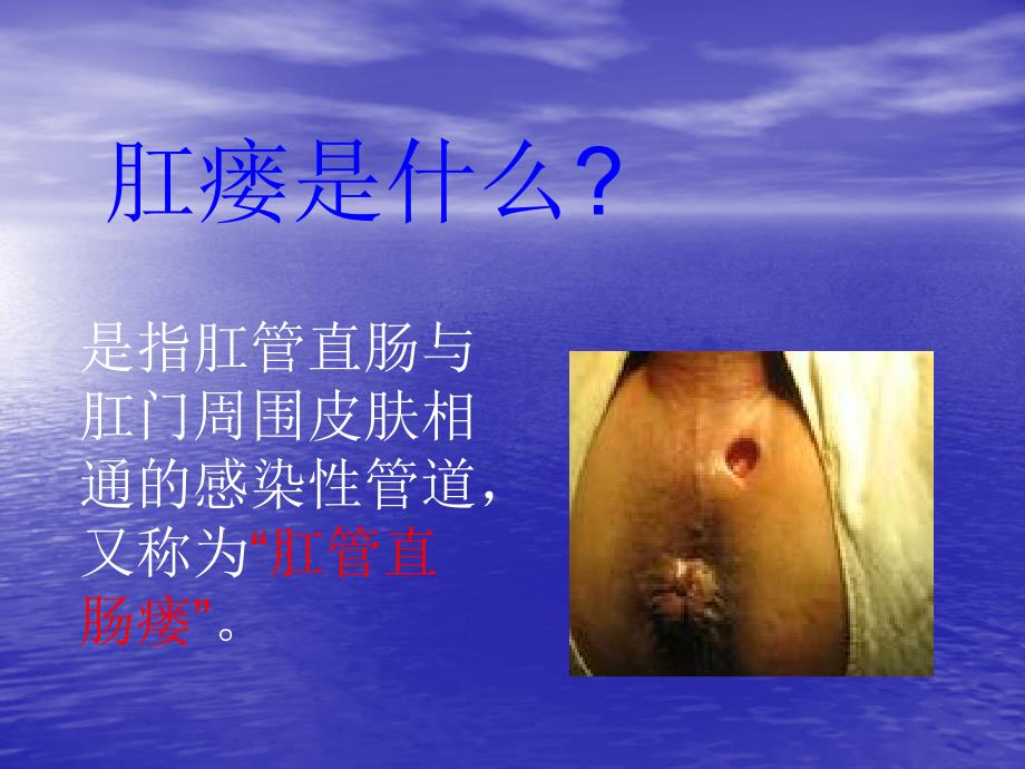 肛瘘PPT课件.ppt_第2页