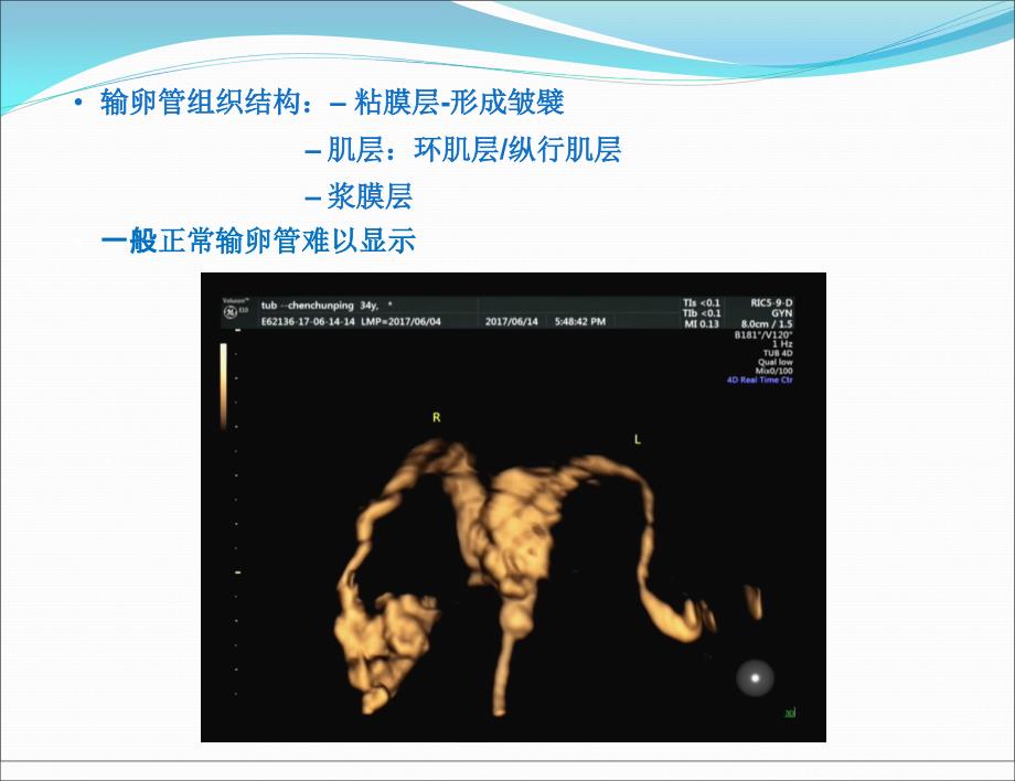 输卵管炎性疾病的超声诊断ppt课件.ppt_第3页