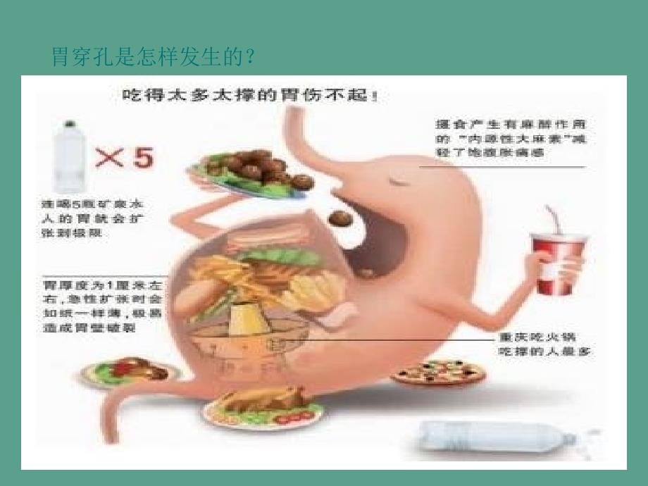 腹腔镜下胃穿孔手术配合ppt课件.ppt_第3页
