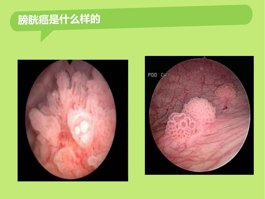非肌层浸润性膀胱癌的诊断治疗.ppt_第2页