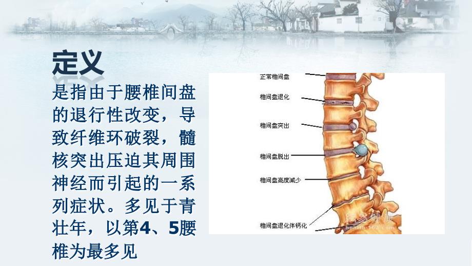 腰椎间盘突出护理.ppt_第3页