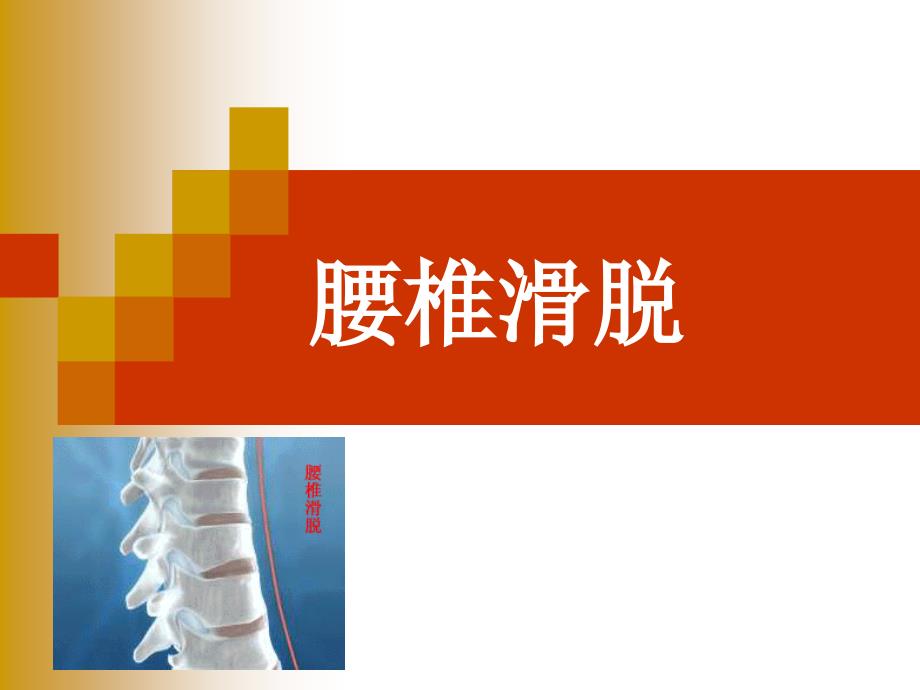 腰椎滑脱ppt课件.ppt_第1页