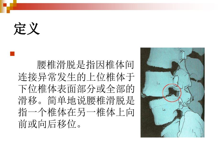 腰椎滑脱ppt课件.ppt_第2页