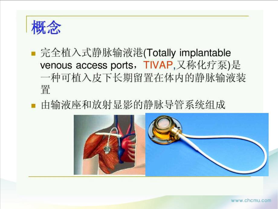 输液港及护理PPT课件.ppt_第3页