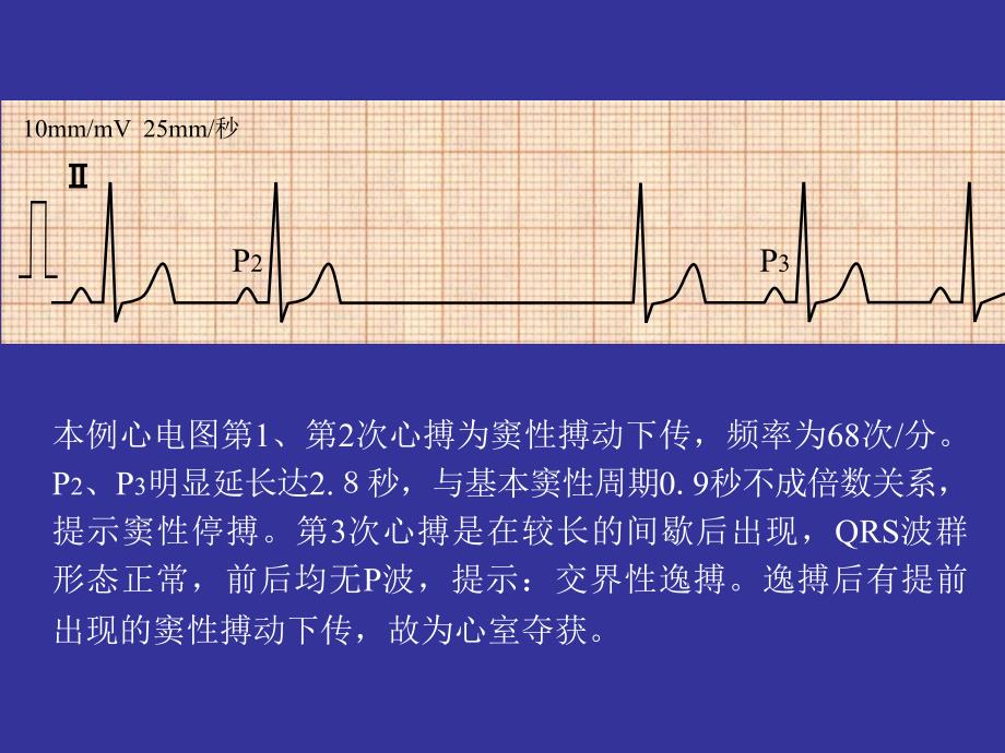 逸搏及逸搏心律PPT课件.ppt_第3页