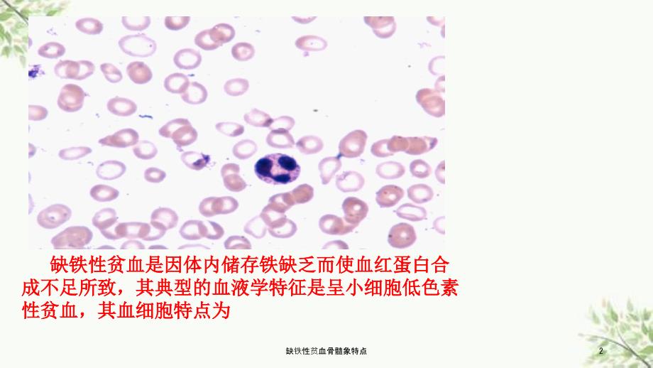 缺铁性贫血骨髓象特点课件.ppt_第2页