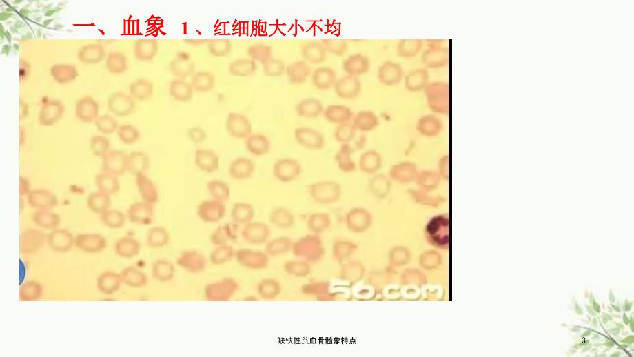 缺铁性贫血骨髓象特点课件.ppt_第3页